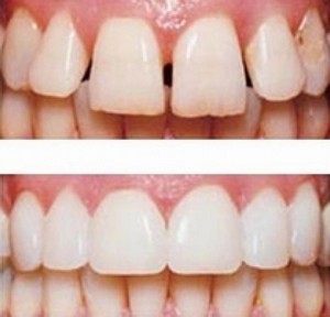 Реставрация зубов - "до" и "после"